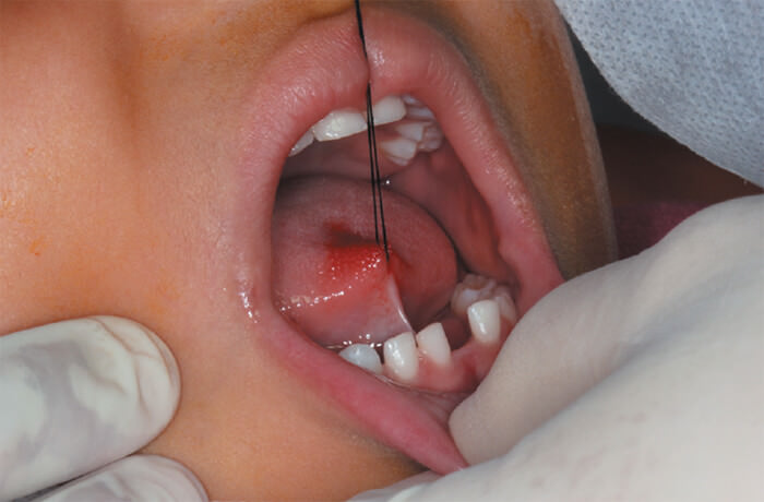 Figura 2. Transfijación de hilo de sutura de seda en la extremidad de la lengua y diastema presente ente incisivos inferiores.