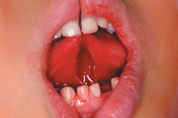 Figura 4. Remoción del frenillo lingual con bisturí, incisión en forma de rombo, divulsión de la lengua.