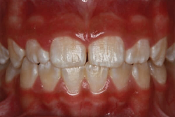 Figura 1. Fluorosis dental