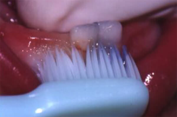 Figura 4. Cepillado de los primeros dientes deciduos.