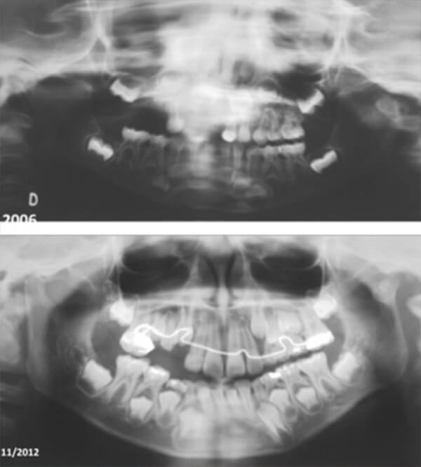 Figura 8. Caso 9: Radiografía panorámica inicial en la que se observa fractura del cuello del cóndilo izquierdo alta dislocada. Radiofrafía a los seis años de seguimiento con alteración en la anatomía.