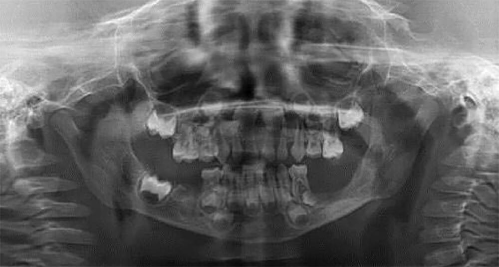 Figure 3: Panoramic radiograph at 3 months reevaluation shows no lesion recurrence and adequate healing of the previously affected areas.