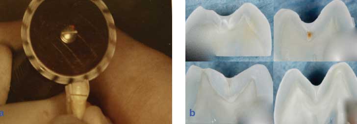 Figura 1. 1a. Cortes con discos rotatorios de diamante de 1 filo (Brasseler Diamond Rotating, Brasseler Dental, GA, USA), 1b. Cortes realizados a las muestras.