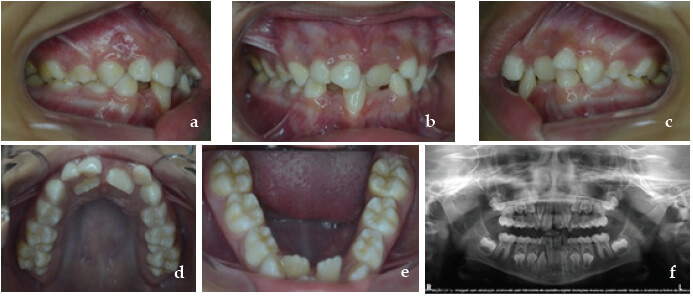 Figura 3. Mordida cruzada anterior dental, hay una relación de clase I posterior y cruce dental de los incisivos centrales superiores y trauma oclusal con recesión gingival en el incisivo inferior (a,b,c), atresia maxilomandibular (d,e) y retención prolongada de dientes primarios (d,f).