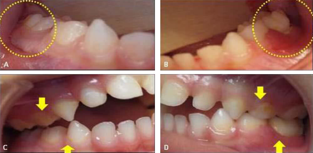 Figure 1: (A) Intra-oral images show reddened and swollen gingiva around lower second right primary molar. (B) A localized swelling and a hemorrhagic appearance of the gingiva in the facial surface of the lower primary left molars. (C) Plaque retention is noticed on the patient’s right upper and lower quadrants. (D) Plaque retention is greatly evident on patient’s left upper and lower quadrant